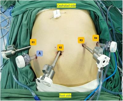 Robot-assisted laparoscopic combined with endoscopic partial gastrectomy (RALE-PG) for the treatment of gastric gastrointestinal stromal tumors in challenging anatomical locations: single-center experience